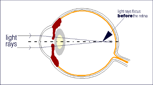 μυωπία (from:Cornea Genetic Eye Institute)