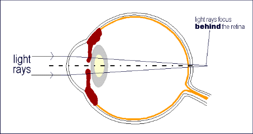 hyperopia (from:Cornea Genetic Eye Institute)