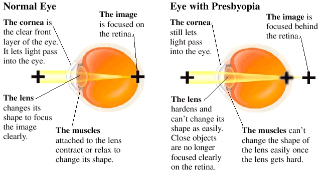 πρεσβυωπία (from: www.healthline.com)