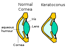 keratoconus-schematic (from:wikipedia)