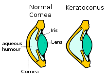 keratoconus - schematic