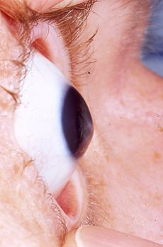 keratoconus (from:wikipedia) 