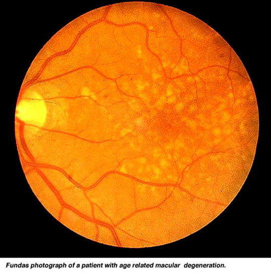 macula degeneration (from:Utah University)