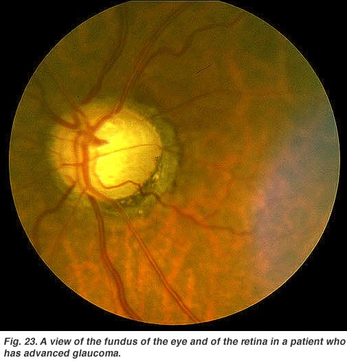 glaucoma (from: Utah University)