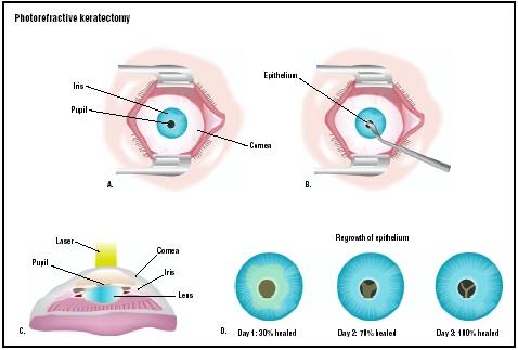 prk (from: Encyclopedia of Surgery)