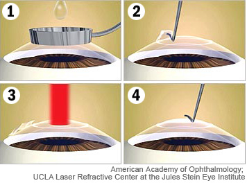 LASEK (from: American Academy of Ophthalmology)