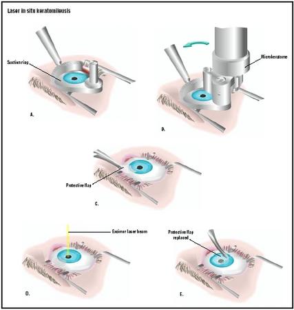 LASIK (from: Encyclopedia of Surgery)