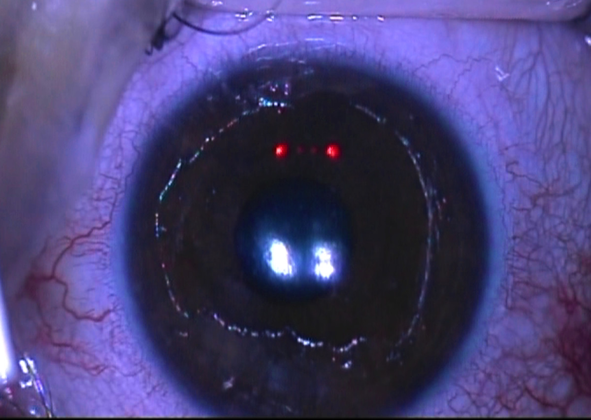 removed corneal epithelium during CXL (photo: VEIC)