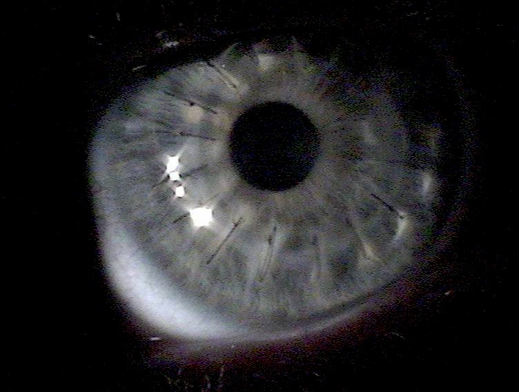 corneal trasplantation (from wikipedia)