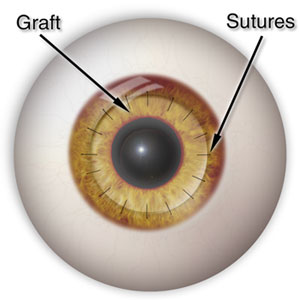 διαμπερής κερατοπλαστική (from:www.center-for-sight.com)